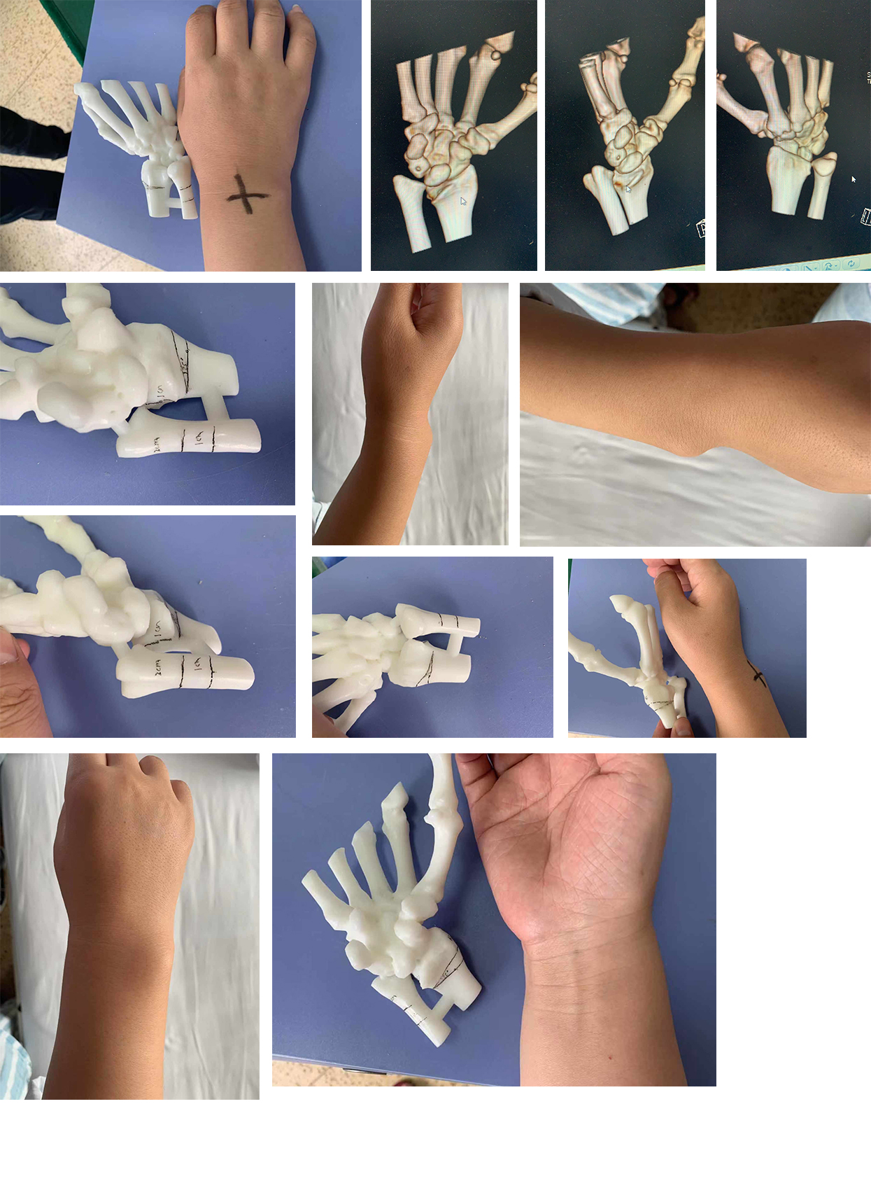 “手指上的艺术”，并指畸形矫正|软组织|矫正|手指|指骨|肌腱|皮肤|先天性并指畸形|-健康界