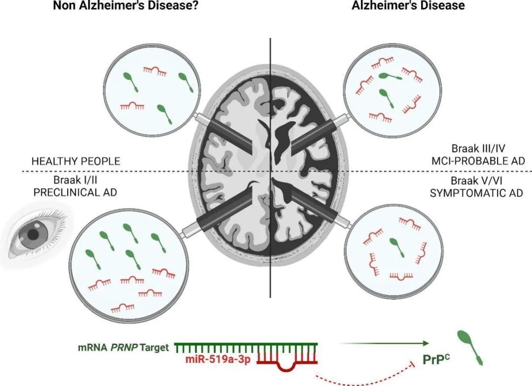 诊断无症状阶段阿尔茨海默病的新生物标志物- OFweek医疗科技网