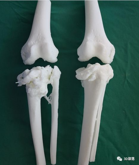 首例3d打印人工膝关节置换手术为患者私人订制
